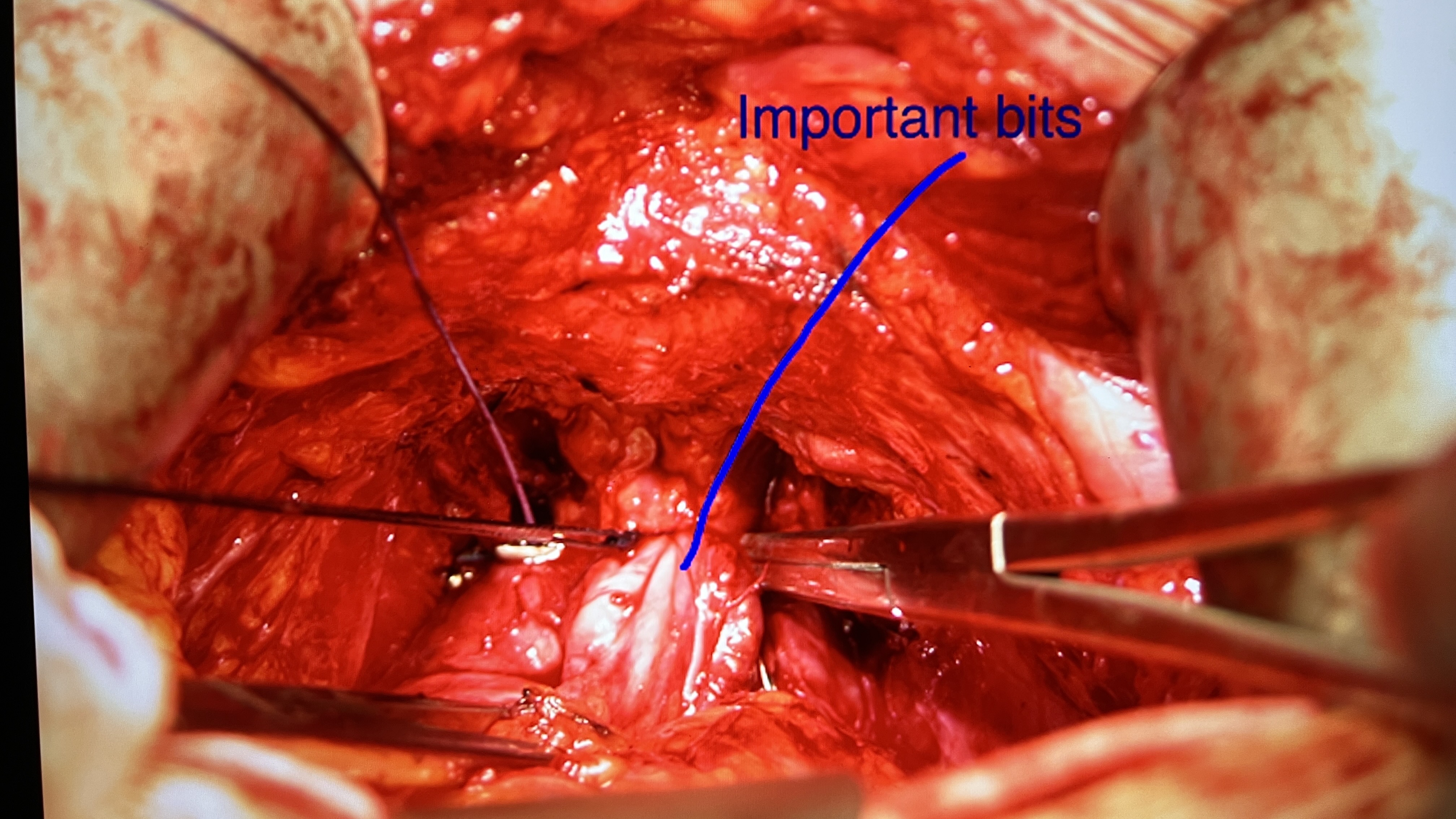 Surgical-field example from prostate cancer treatment context