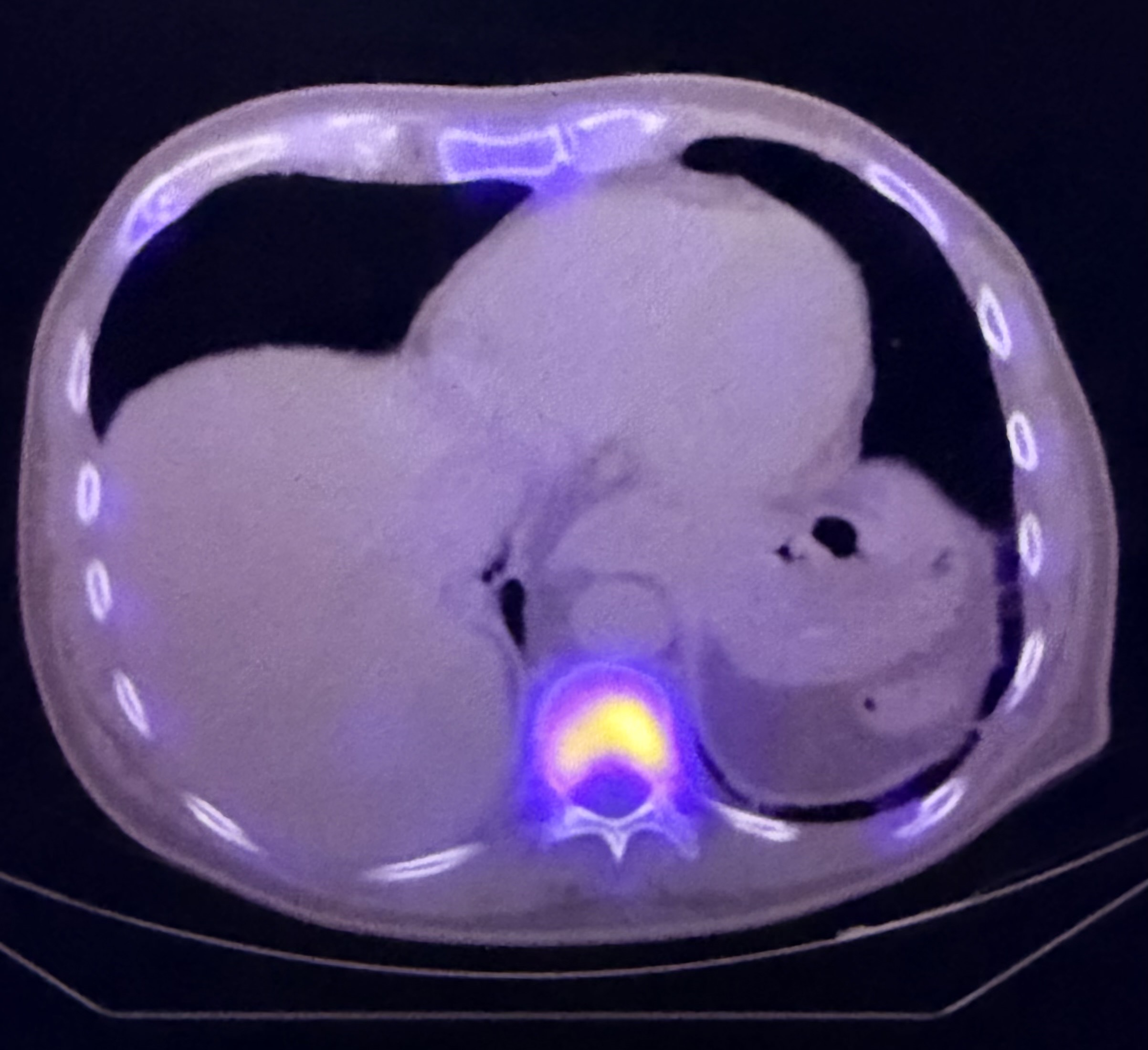 PET/CT example used to illustrate advanced cancer staging